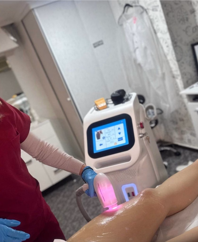 Epilare Definitva Laser 4 epilare definitva 3